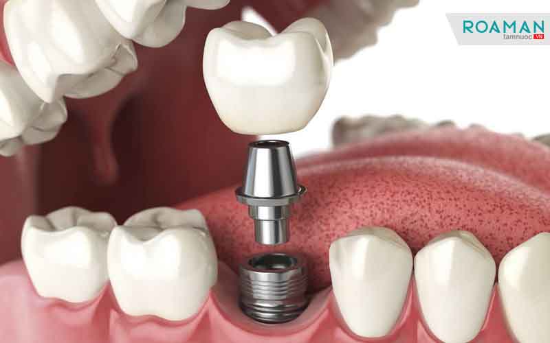 lưu ý gì khi chăm sóc răng miệng sau khi cấy implant