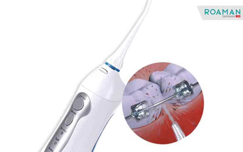 lưu ý gì khi chăm sóc răng miệng sau khi cấy implant