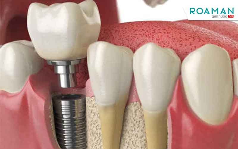 Thói quen xấu sau khi trồng răng implant cần loại bỏ