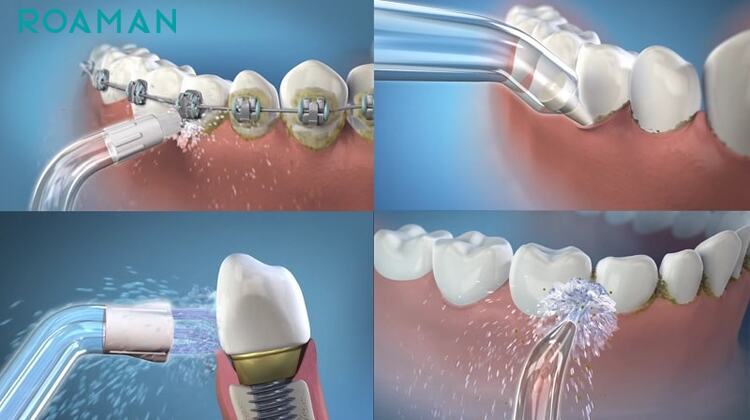 Ưu điểm của máy tăm nước là dễ sử dụng và hiệu quả đặc biệt đối với người niềng răng