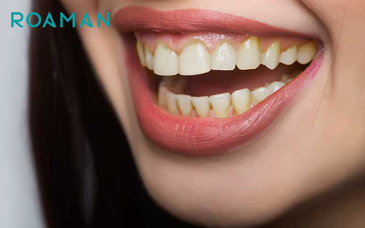 Răng ố vàng là dấu hiệu của mòn men răng