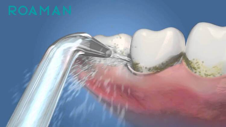 Máy tăm nước đã được chứng minh là có hiệu quả tốt khi loại bỏ mảng bám giữa các kẽ răng