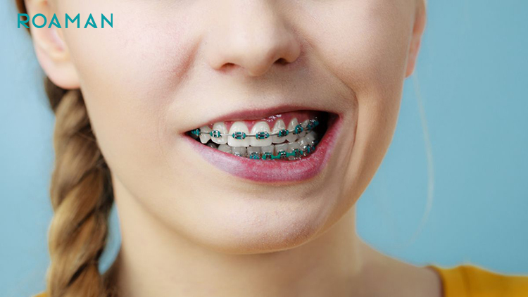 Niềng răng có thể khiến răng có đốm trắng
