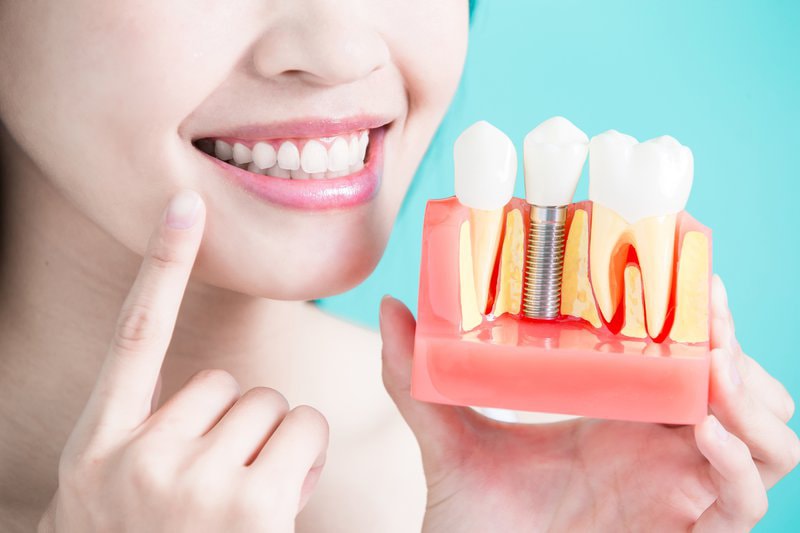 Bí quyết để chăm sóc răng sau khi cấy implant. (Ảnh: Internet)