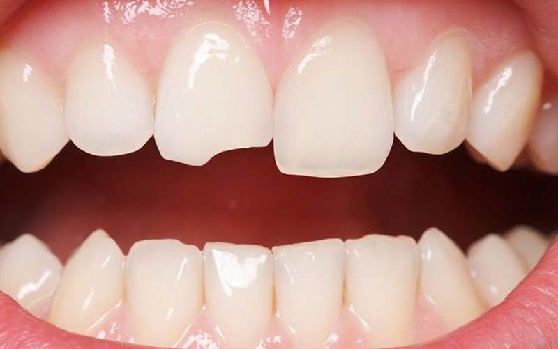 Cách phòng ngừa và khắc phục khi răng mẻ