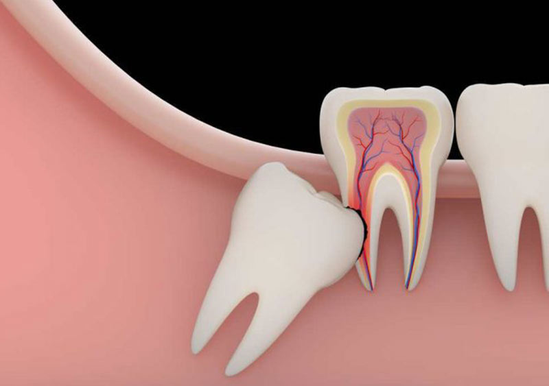 thực phẩm người nhổ răng khôn nên ăn để mau lành