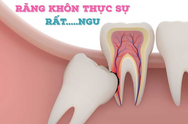 Răng khôn mọc ngầm gây xô lệch răng