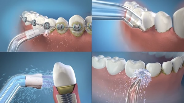 Máy tăm nước sẽ là giải pháp tốt để làm sạch kẽ răng khi bạn niềng răng